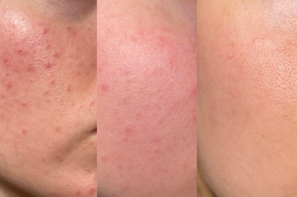 Mejora de cicatrices y textura de la piel