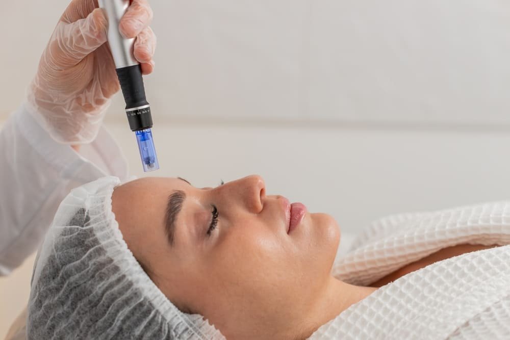 Microagujas (Microneedling)